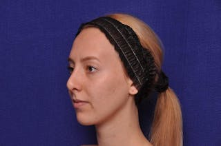 Rhinoplasty Before & After Gallery - Patient 198172 - Image 4