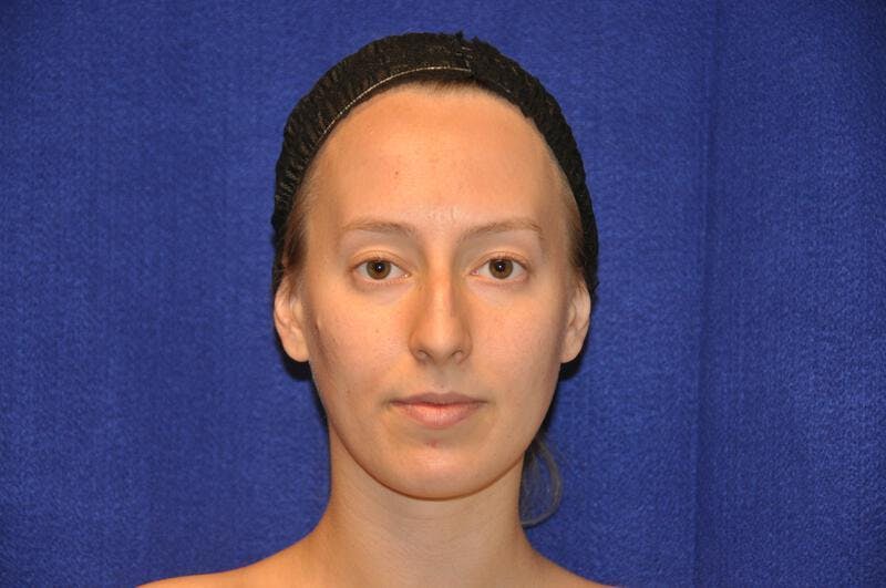 Rhinoplasty Before & After Gallery - Patient 198172 - Image 5