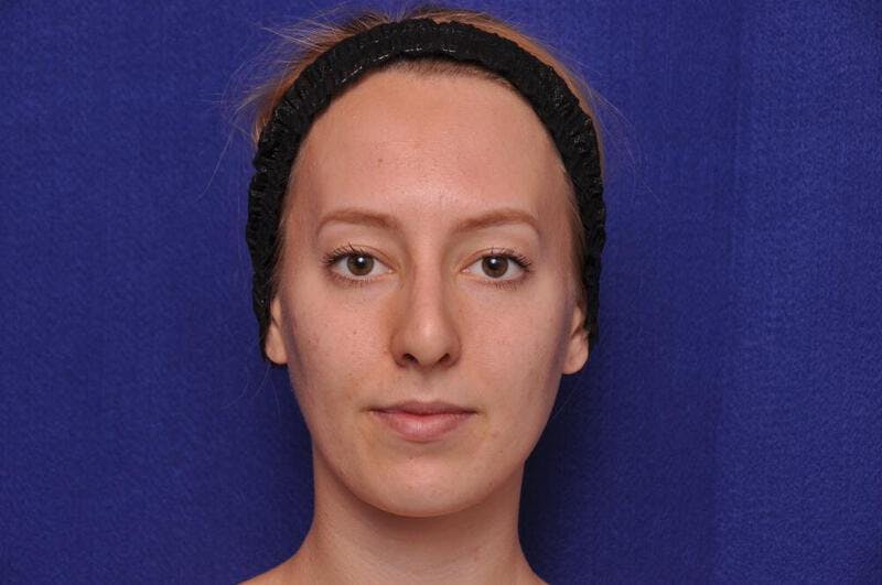 Rhinoplasty Before & After Gallery - Patient 198172 - Image 6