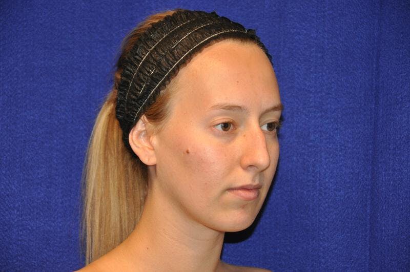 Rhinoplasty Before & After Gallery - Patient 198172 - Image 7