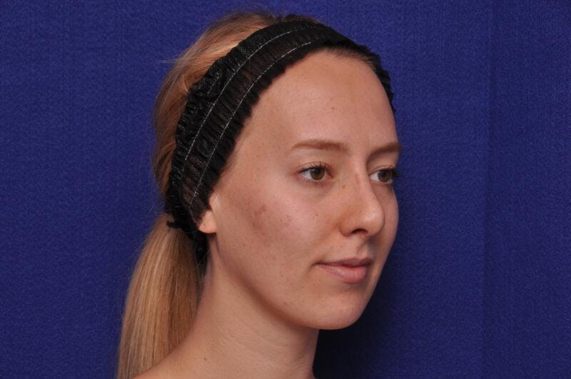 Rhinoplasty Before & After Gallery - Patient 198172 - Image 8