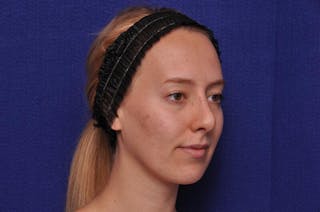 Rhinoplasty Before & After Gallery - Patient 198172 - Image 8