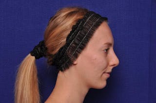 Rhinoplasty Before & After Gallery - Patient 198172 - Image 10