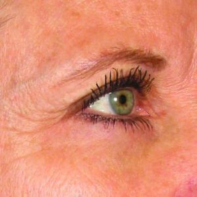 Ultherapy Before & After Gallery - Patient 361390 - Image 1
