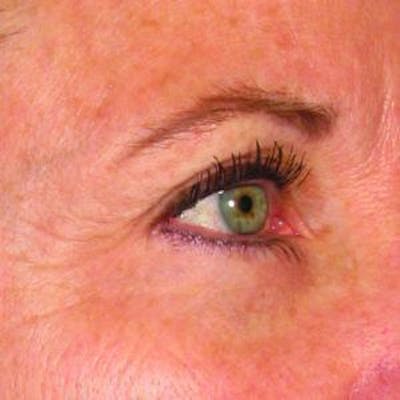 Ultherapy Before & After Gallery - Patient 361390 - Image 2