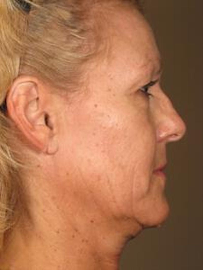 Ultherapy Before & After Gallery - Patient 276730 - Image 1
