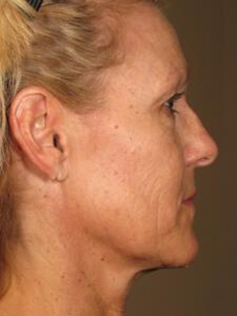 Ultherapy Before & After Gallery - Patient 276730 - Image 2