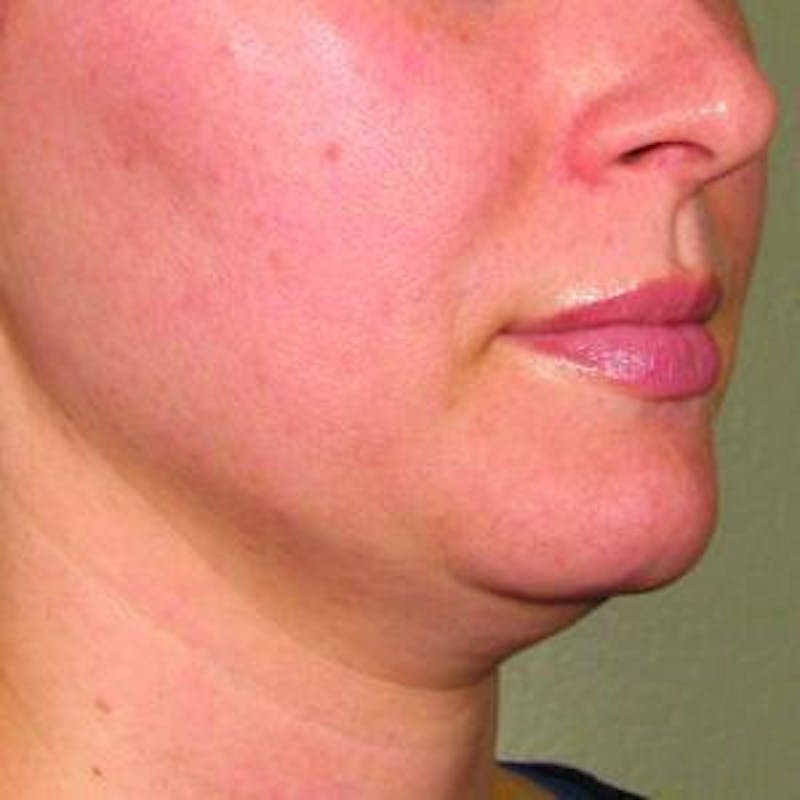 Ultherapy Before & After Gallery - Patient 377203 - Image 1