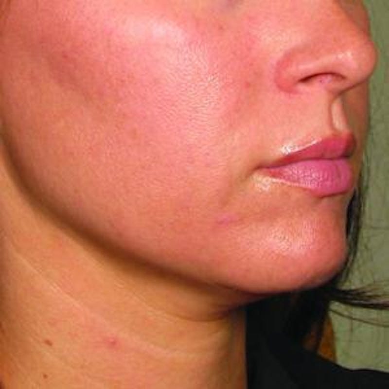 Ultherapy Before & After Gallery - Patient 377203 - Image 2