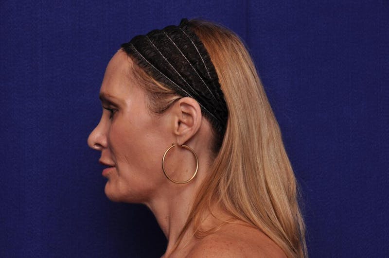 Upper Blepharoplasty Before & After Gallery - Patient 439261 - Image 4