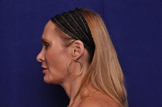 Upper Blepharoplasty Before & After Gallery - Patient 439261 - Image 4