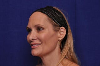 Upper Blepharoplasty Before & After Gallery - Patient 439261 - Image 6