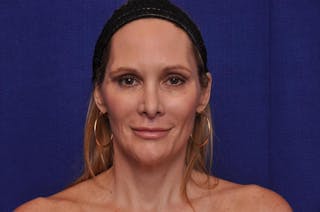 Upper Blepharoplasty Before & After Gallery - Patient 439261 - Image 2