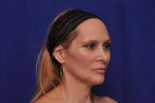 Upper Blepharoplasty Before & After Gallery - Patient 439261 - Image 8