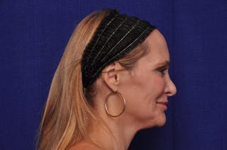 Upper Blepharoplasty Before & After Gallery - Patient 439261 - Image 10