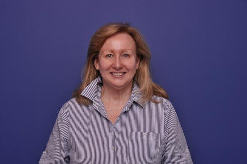 Upper Blepharoplasty Before & After Gallery - Patient 274007 - Image 1