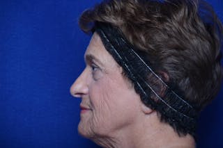 Upper Blepharoplasty Before & After Gallery - Patient 368987 - Image 4