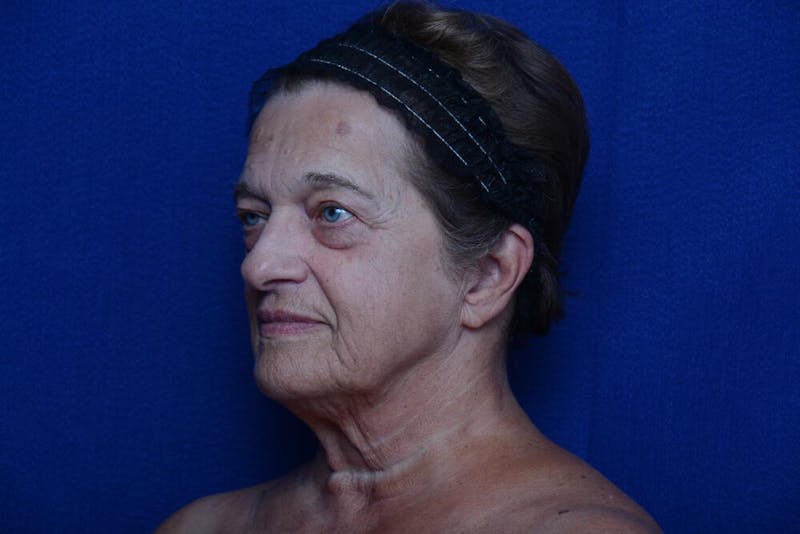 Upper Blepharoplasty Before & After Gallery - Patient 368987 - Image 5