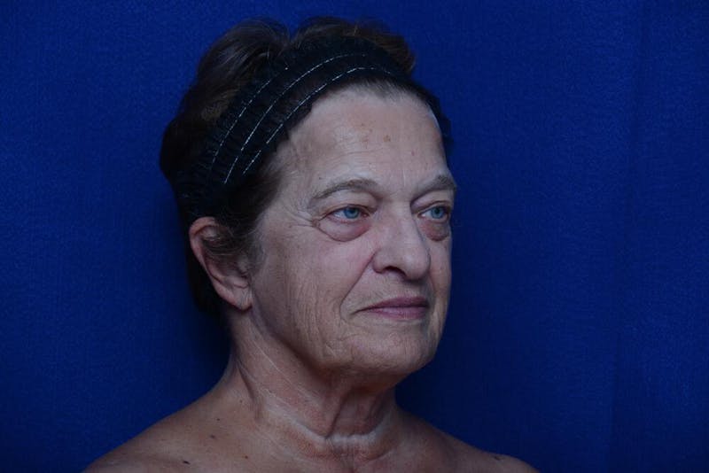 Upper Blepharoplasty Before & After Gallery - Patient 368987 - Image 7
