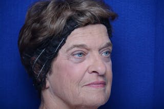 Upper Blepharoplasty Before & After Gallery - Patient 368987 - Image 8