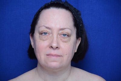 Upper Blepharoplasty Before & After Gallery - Patient 252215 - Image 1