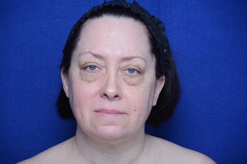 Upper Blepharoplasty Before & After Gallery - Patient 252215 - Image 1