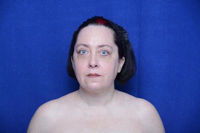 Upper Blepharoplasty Before & After Gallery - Patient 252215 - Image 2