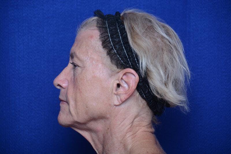 Upper Blepharoplasty Before & After Gallery - Patient 277454 - Image 3