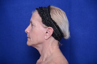 Upper Blepharoplasty Before & After Gallery - Patient 277454 - Image 4