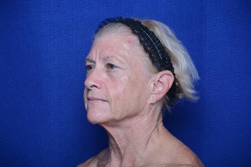 Upper Blepharoplasty Before & After Gallery - Patient 277454 - Image 5
