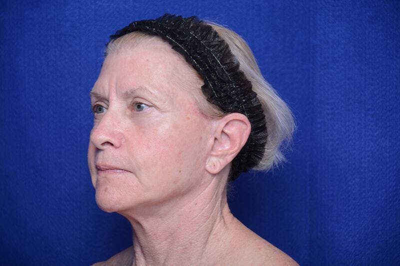 Upper Blepharoplasty Before & After Gallery - Patient 277454 - Image 6