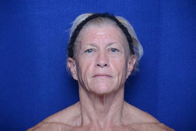 Upper Blepharoplasty Before & After Gallery - Patient 277454 - Image 1