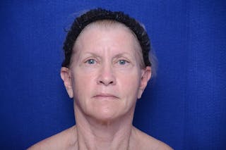 Upper Blepharoplasty Before & After Gallery - Patient 277454 - Image 2