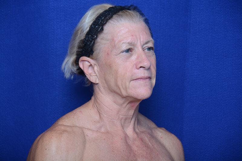 Upper Blepharoplasty Before & After Gallery - Patient 277454 - Image 7