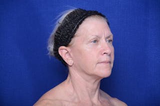 Upper Blepharoplasty Before & After Gallery - Patient 277454 - Image 8