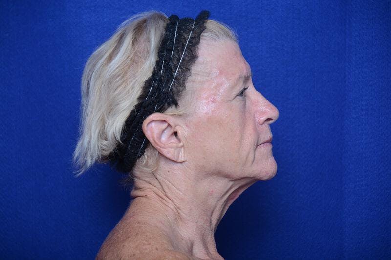 Upper Blepharoplasty Before & After Gallery - Patient 277454 - Image 9