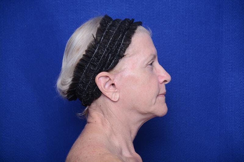 Upper Blepharoplasty Before & After Gallery - Patient 277454 - Image 10