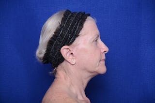 Upper Blepharoplasty Before & After Gallery - Patient 277454 - Image 10