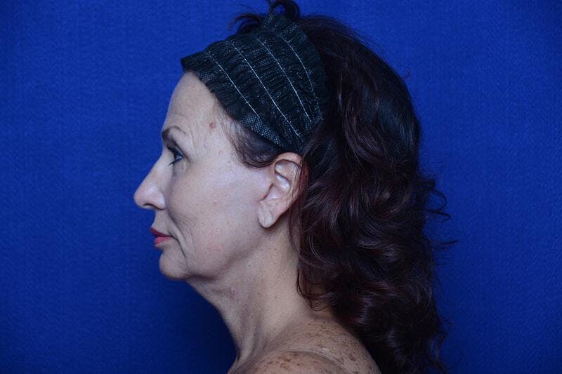 Upper Blepharoplasty Before & After Gallery - Patient 240986 - Image 4