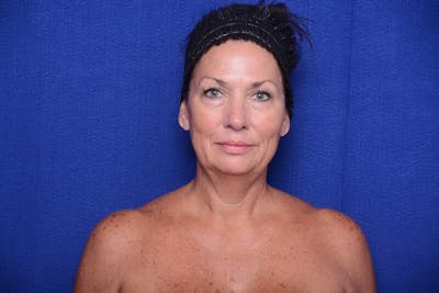 Upper Blepharoplasty Before & After Gallery - Patient 240986 - Image 1