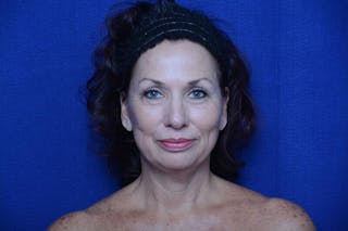 Upper Blepharoplasty Before & After Gallery - Patient 240986 - Image 2