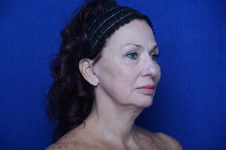 Upper Blepharoplasty Before & After Gallery - Patient 240986 - Image 8