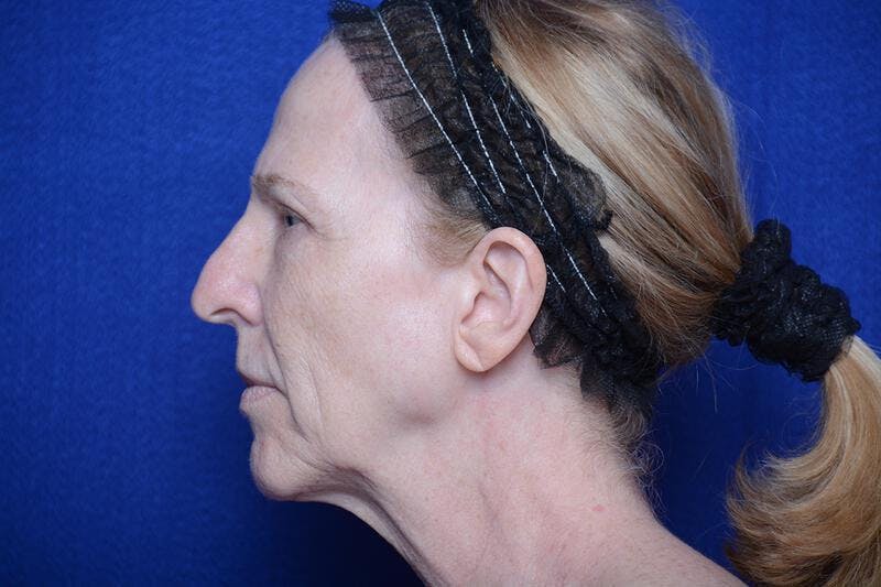 Upper Blepharoplasty Before & After Gallery - Patient 317052 - Image 3