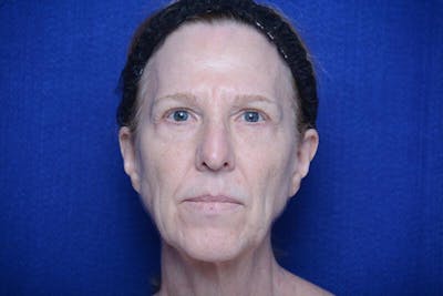 Upper Blepharoplasty Before & After Gallery - Patient 317052 - Image 1