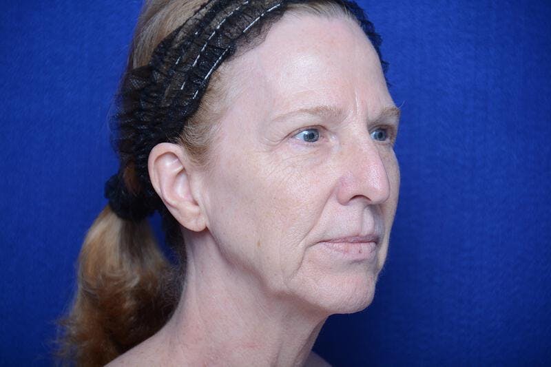 Upper Blepharoplasty Before & After Gallery - Patient 317052 - Image 7