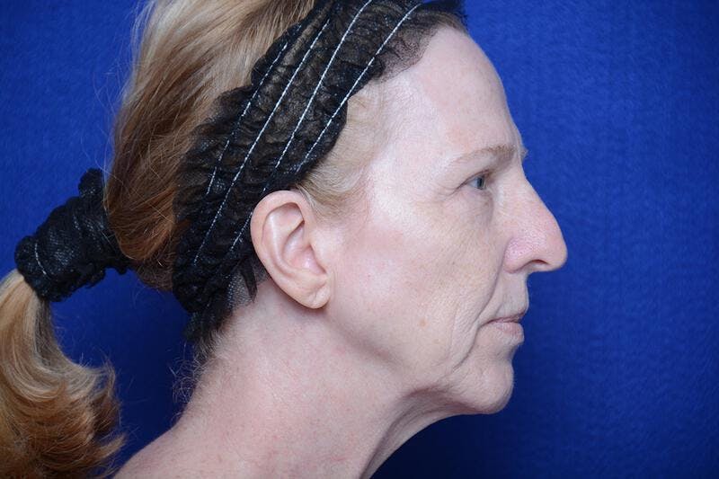 Upper Blepharoplasty Before & After Gallery - Patient 317052 - Image 9