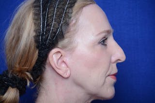 Upper Blepharoplasty Before & After Gallery - Patient 317052 - Image 10