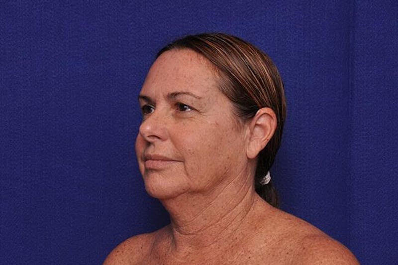 Upper Blepharoplasty Before & After Gallery - Patient 284337 - Image 3
