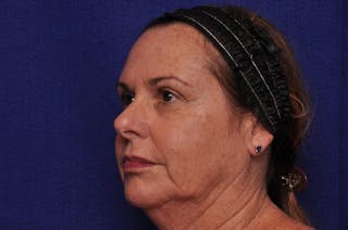 Upper Blepharoplasty Before & After Gallery - Patient 284337 - Image 4