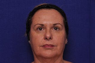 Upper Blepharoplasty Before & After Gallery - Patient 284337 - Image 2